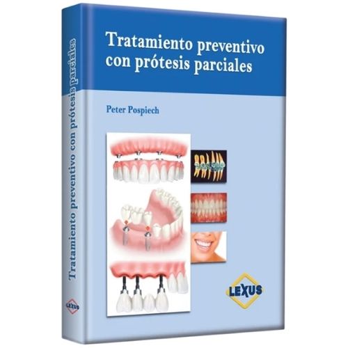 TRATAMIENTO PREVENTIVO CON PROTESIS PARCIALES - PETER POSPIE